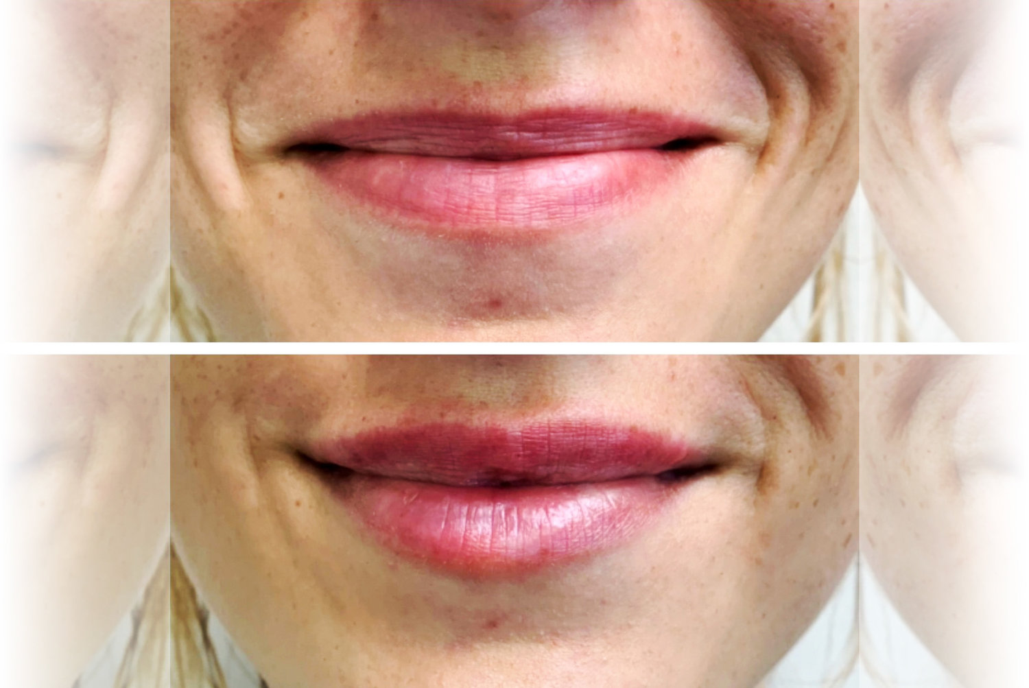 Before and after a Restylane treatment