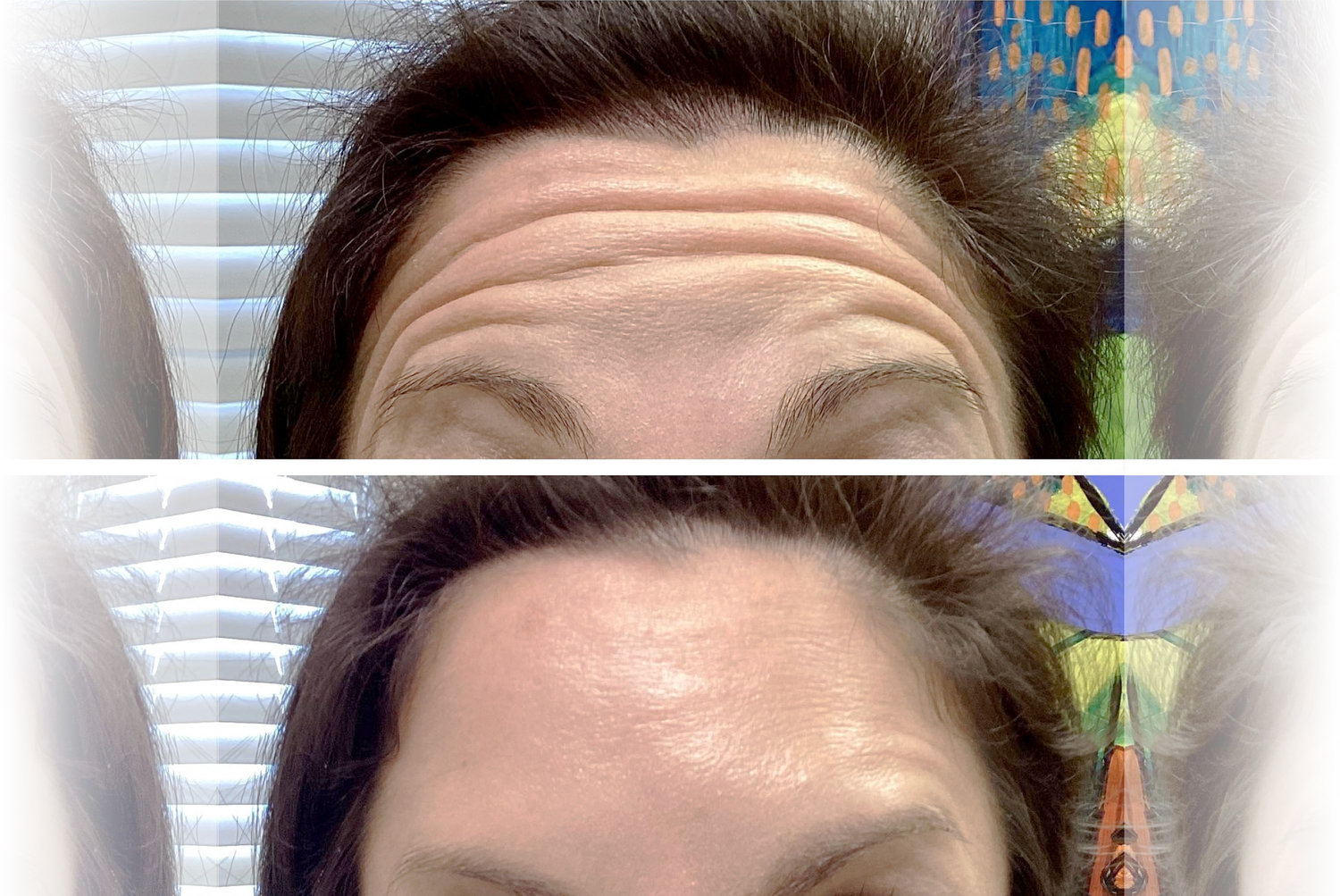 Before and two weeks after a first-time Dysport treatment at Macrae Medical Associates